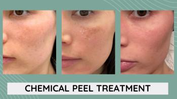 Before and After Precautions for Chemical Peel Treatment