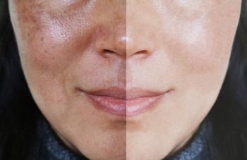 Melasma Peel