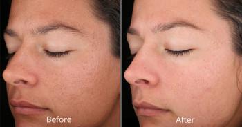 Salicylic Peel